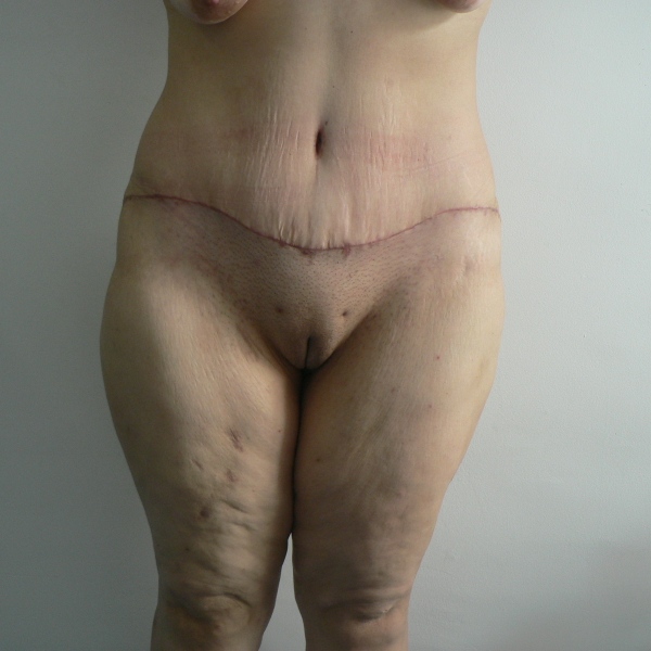 abdomino caz13-post1