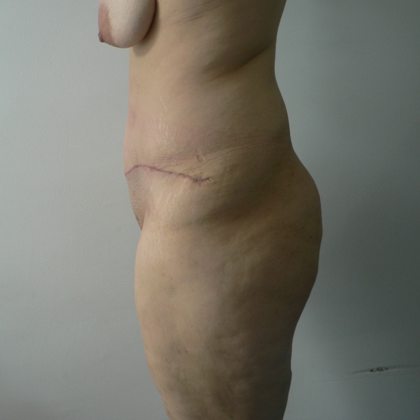 abdomino caz13-post3