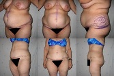 poze abdominoplastie caz#1