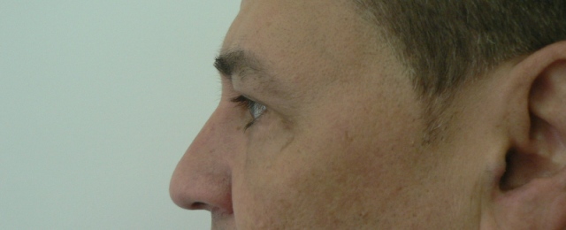 blefaroplastie caz11-post3