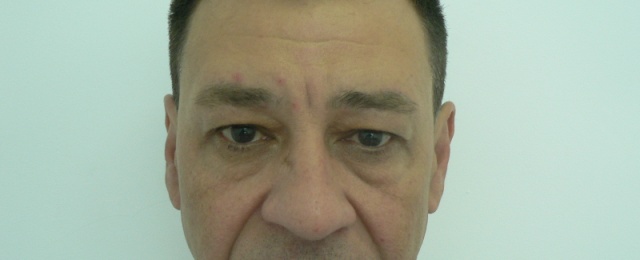 blefaroplastie caz11-pre1