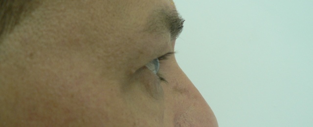 blefaroplastie caz11-pre2