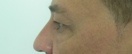 blefaroplastie caz11-pre3