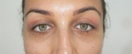 blefaroplastie caz14-post1