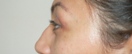 blefaroplastie caz14-post2