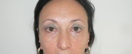 blefaroplastie caz15-post1