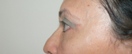 blefaroplastie caz15-post2