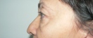 blefaroplastie caz15-pre2