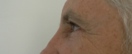 blefaroplastie caz16-post2