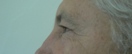 blefaroplastie caz16-pre2