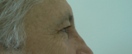 blefaroplastie caz16-pre3