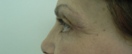 blefaroplastie caz17-post2