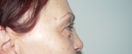 blefaroplastie caz17-pre3
