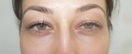 blefaroplastie caz18-post1