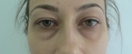 blefaroplastie caz18-pre1