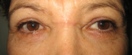 blefaroplastie caz2-post1