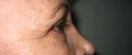 blefaroplastie caz2-post3