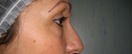 blefaroplastie caz3-pre3