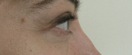 blefaroplastie caz4-post3