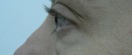 blefaroplastie caz4-pre2