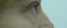 blefaroplastie caz4-pre3