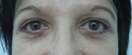 blefaroplastie caz6-post1