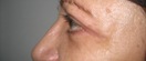 blefaroplastie caz6-post2