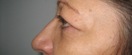 blefaroplastie caz6-pre2