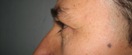 blefaroplastie caz7-pre2