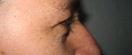 blefaroplastie caz7-pre3