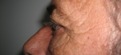 blefaroplastie caz8-post2