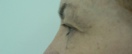 blefaroplastie caz9-pre2