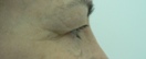 blefaroplastie caz9-pre3