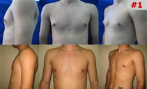 detalii ginecomastie (barbati) caz#1