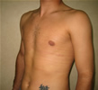 ginecomastie caz1-post2