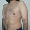 ginecomastie caz10-post2