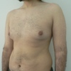 ginecomastie caz10-pre2