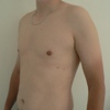 ginecomastie caz11-post2