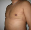 ginecomastie caz2-post3