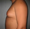ginecomastie caz2-pre1