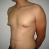 ginecomastie caz3-pre2