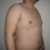 ginecomastie caz5-post2