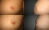 Poze mameloane invaginate