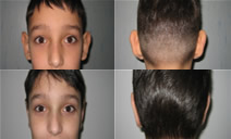 poze rinoplastie caz#1